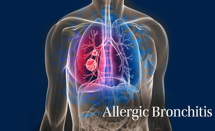 Allergic bronchitis Treatment