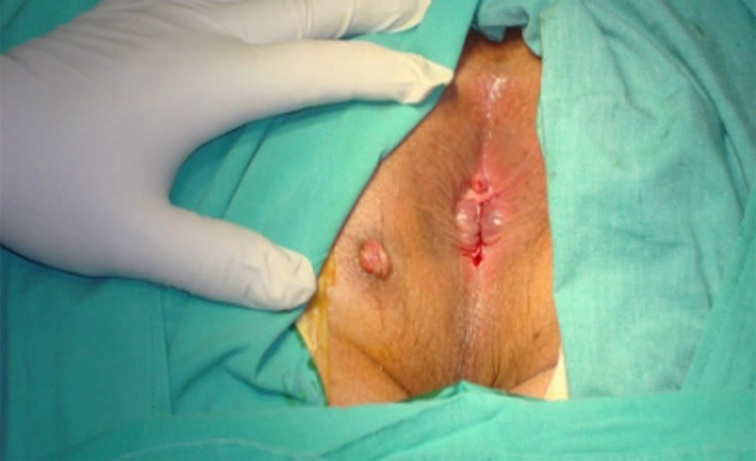 Fistula Treatment