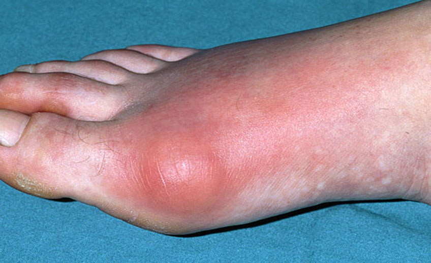 Gout Problem