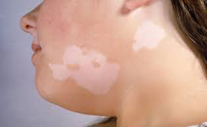 Leucoderma Treatment