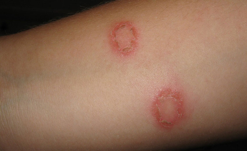 Ringworm  Treatment